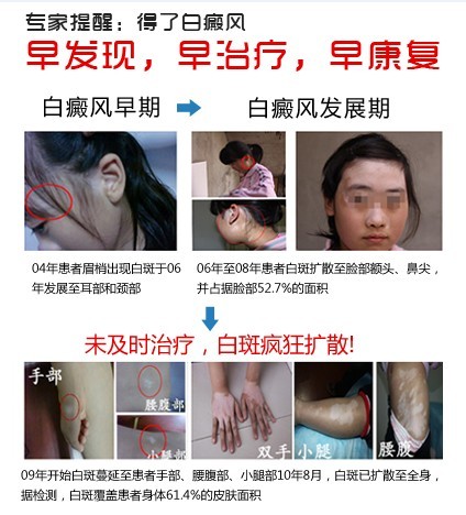西安白癜风医院